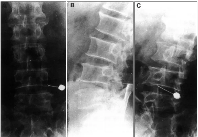Fig. 1. Plain AP(A), lateral(B), and oblique(C) film demonstrating correct position of the needle at the lower margin of L4  pedicle for the nerve root infiltration