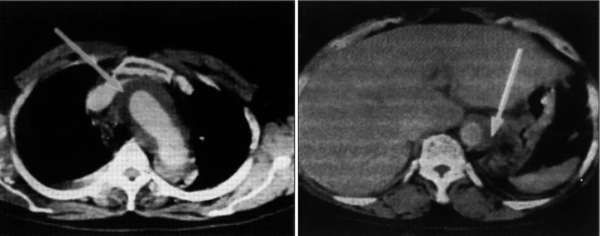 Fig. 1. Contrast enhanced computed tomography shows type  Ⅰ  aortic dissection, arrow(false lumen)
