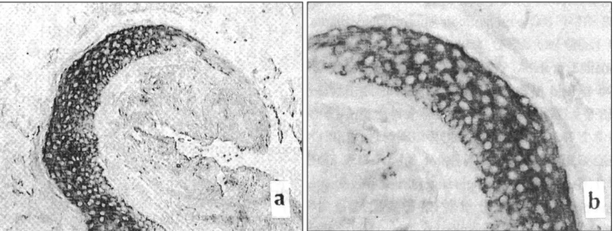 Table 1. Expression of EGFR-mRNA by in situ hybridization 