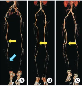 Fig. 2. Configurations used in infrainguinal bypass surgery  with a composite graft in the absence of an appropriate  single segment vein graft (yellow arrows: anastomosis  be-tween polytetrafluoroethylene graft and vein graft)