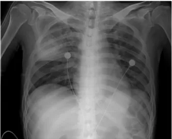 Figure 1. Chest X-ray showing diffused consolidation and air  bronchogram in the right upper lobe.