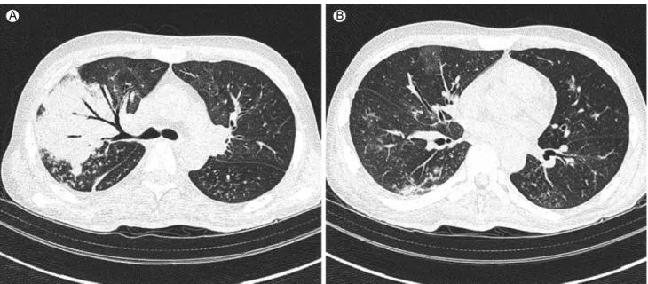 Figure 2. Chest computed tomography showing multifocal patchy consolidation and nodules in the right upper lobe (A), and diffuse mild  bronchial wall thickening in both lung fields (B).