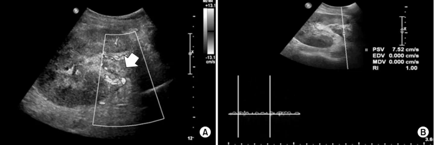 Fig. 1. Ultrasonography shows (A) filling defect (arrow) in main renal vein of allograft kidney and increased parenchyma echogenicity,  and (B) absent venous blood flow (resistive index [RI]=0.75)