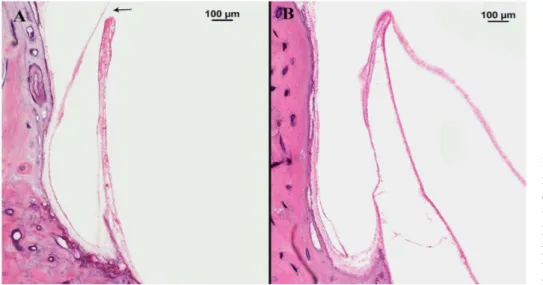 Fig. 1. Horizontal sections of hu- hu-man temporal bones showing the  endolymphatic sinus and the Bast valve in bones from 2 donors who  had of Ménièreʼs disease  (hematox-ylin and eosin stain)