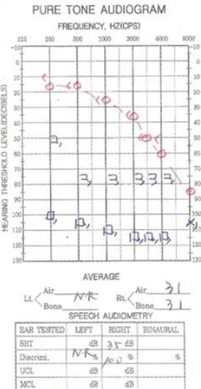 Fig. 2. Video head impulse test  shows decreased gain and catch up saccade on the left side.