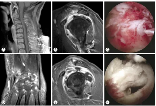 Fig. 2. (A) Cervical magnetic resonance imaging (MRI) showed a small fluid collection over the C6 and C7 spinous processes with rim enhancement (arrows)