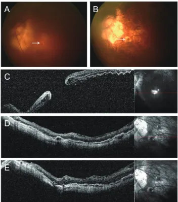 Fig. 1. Fundus photographs and optical coherence tomography. 
