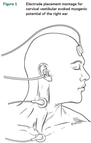 Figure 1 Electrode placement montage for cervical vestibular evoked myogenic potential of the right ear
