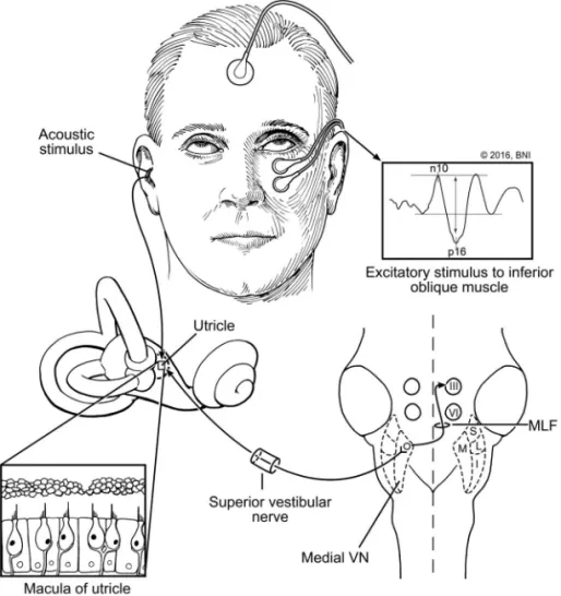 Figure 4 The predominant reflex pathway mediating ocular vestibular evoked myogenic potential responses