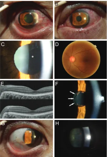Fig. 1. Ocular findings of anterior acute uveitis after administra- administra-tion of intravenous zoledronic acid (A) and (B) slit-lamp  photo-graphs show severe bilateral vascular engorgement of the bulbar  conjunctiva