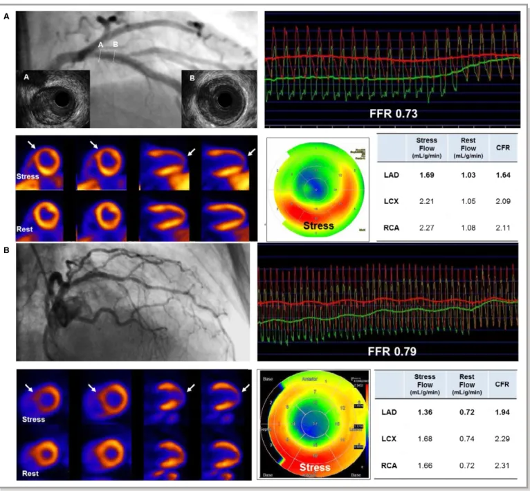 Figure 3. Representative case examples of angiographically insigni ﬁcant stenosis with low FFR