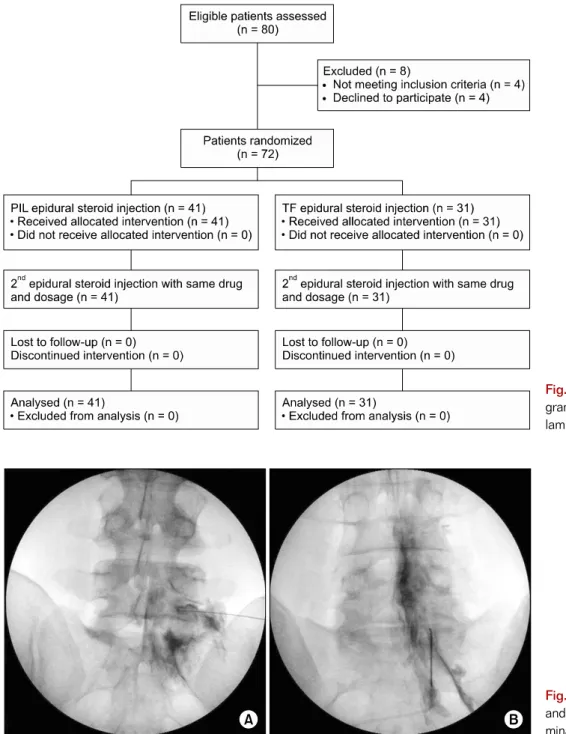 Fig. 2. Transforaminal (A)  and parasagittal (B)  interla-minar epidural injection.