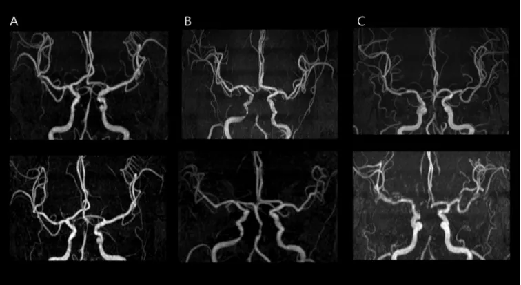 Fig 1. Baseline and follow-up three-dimensional (3D) time-of-flight magnetic resonance angiogram (MRA) of intracranial stenosis