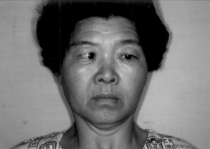 Fig. 2C. Increased soft tissue density on the left superior orbital fissure, orbital apex and cavernous sinus with lateral bulging (empty arrow)