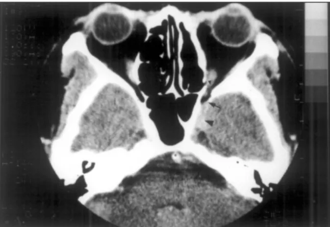 Fig. 4. Clear left ethmoidectomy site with decreased soft  tissue density on the left orbital apex (small arrow head),  superior orbital fsuure (arrow) and cavernous sinus (large 