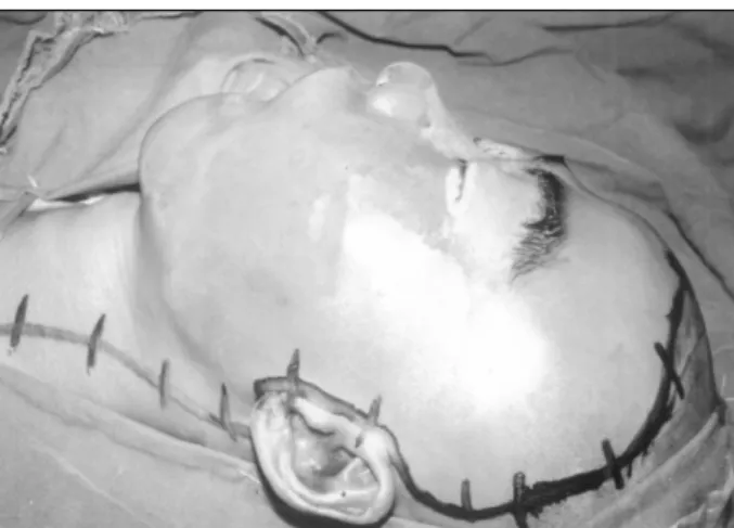Fig. 8. Subtemporal preauricular incision. 