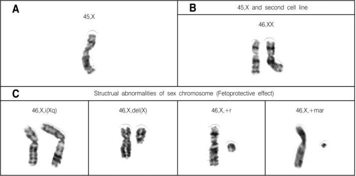 Fig. 2. Schematic  presentation  of  partial  karyotypes  in  Turner  syndrome  patients