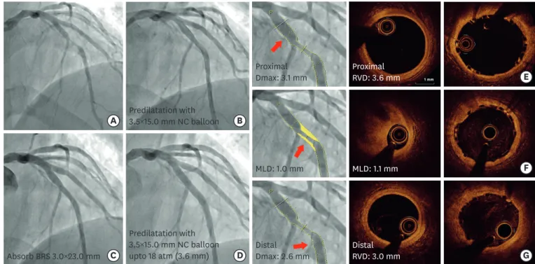 Figure 5. A case of “Effective” PSP. Fifty-seven years old man admitted due to effort related chest pain