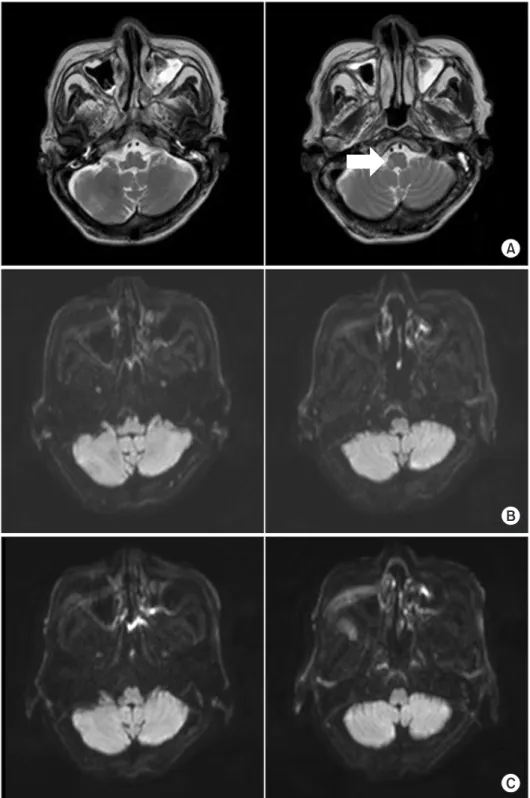 Fig. 1. (A) Initial brain magnetic  resonance imagery (MRI) of  T2-weighted image show subacute  infarction in the right medulla