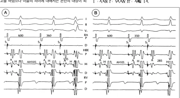 Fig. 1. Intracardiac electrogram during atrial stimulation before slow pathway ablation in a patient with atrioventricular nodal reentrant tachycardia A：cycle length 360 msec, B：cycle length 350 msec, the third stimulated impulse (S 2 ) in associated with 