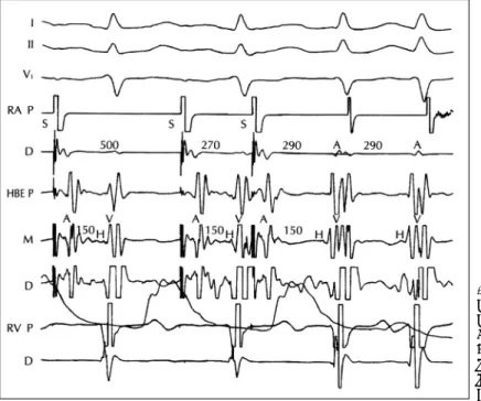 Fig. 3. Initiation of atrioventricular no- no-dal reentry by a atrial premature  depolarization