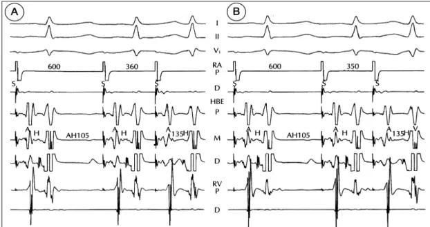 Fig. 4. Intracardiac electrogram during atrial stimulation after successful slow pathway ablation in a same patient in figure 1