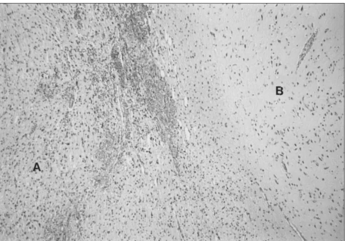 Fig. 3. Dual pathologies in one microscopic field as dysorganized area of cortical dysplasia(A) and neoplastic area(B) of  oligodendrocyte-like cells(OLC)(H &amp; E stain,  ×50)