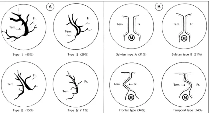 Fig. 1. Patterns of the sylvian veins(A) and the variations of sylvian cisterns(B). Fr＝frontal lobe, Tem＝temporal lobe(From  Aydin IH, Kadioglu HH, Tuzun Y, et al：The variations of sylvian veins and cisterns in anterior circulation aneurysms