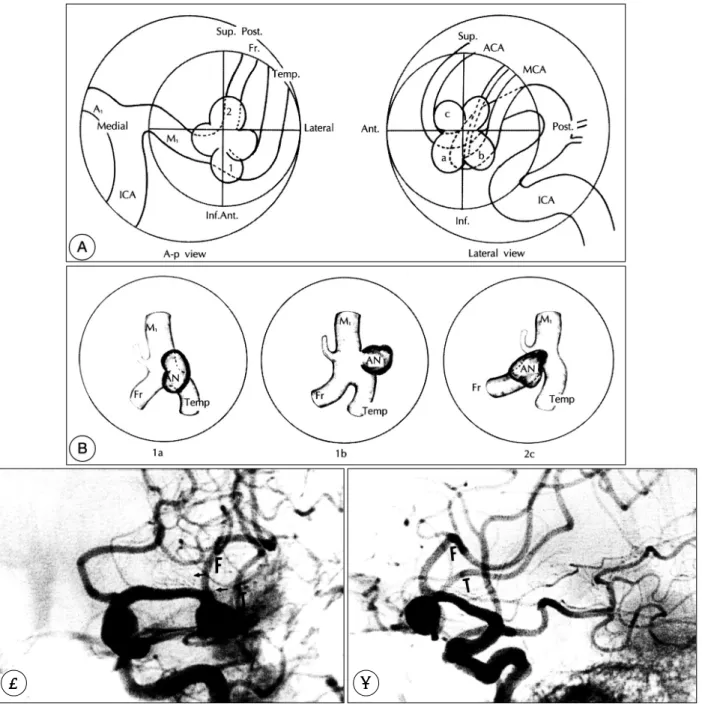 Fig. 5. Classification of the directions of the middle cerebral artery aneurysm in the carotid angiogram(A)