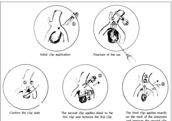 Fig. 7. The sequence of the clipping of the middle cerebral artery aneurysm.