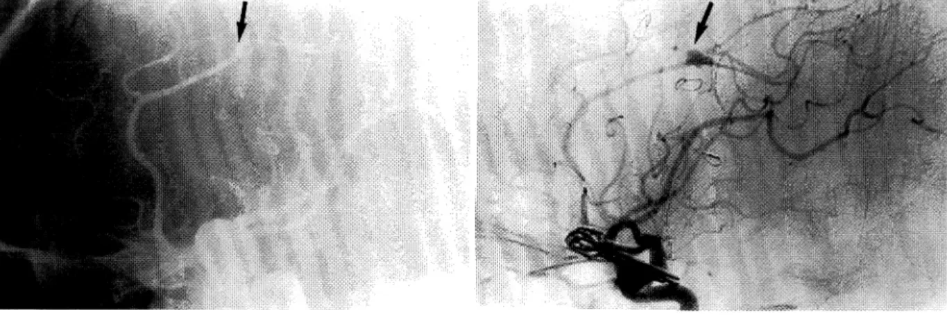 Table  1  Clinical  summary  at  the  time  of  the  initial  surgery#