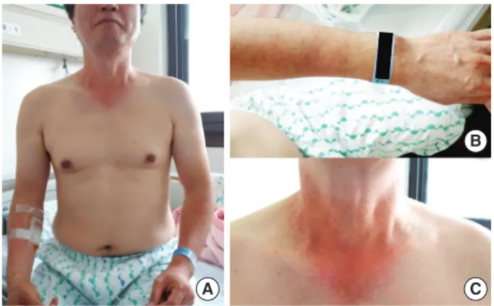 Fig. 2. Maculopapular eruptions on the upper body with a photodistributed pat- pat-tern (A), localized in the forearm and the dorsal area of the hand (B), and the  neck with V-neck sign (C) at presentation