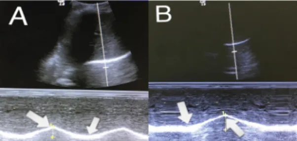 Fig.  1.  Using  a  tape  measure  to  measure  the  lower  thoracic  mobility