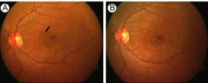 Figure 2. Fundus photographs of a patient’s left eye showing ret- ret-inal involvement