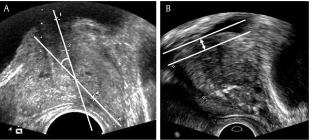 Fig. 1. Ultrasonographic measurement of prostatic urethral angle and Intravesical prostatic protrusion
