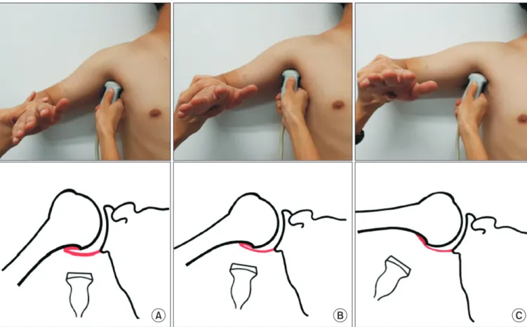 Fig. 1. Evaluation of the axillary recess capsule, using ultrasonography and schematic drawings, at three different posi- posi-tions according to the degrees of shoulder abduction (50 o , 70 o , and 90 o ).
