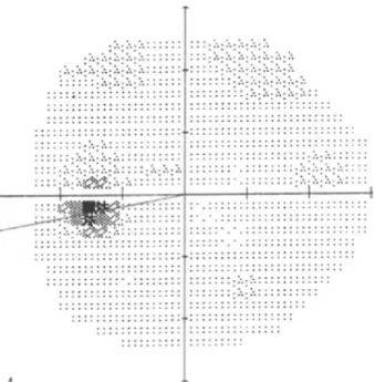 Figure 2. A construction example of the centro-cecal axis for  the purpose of centro-cecal axis rotation (CCAR) torsion  measurement from the visual field chart