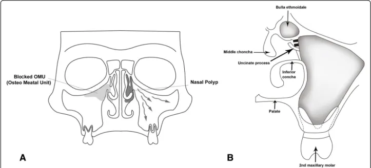 Fig. 1 A coronal schematic representation of the posterior maxillary teeth with the sinonasal complex