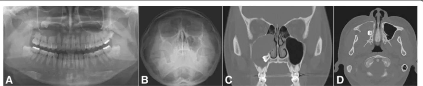 Fig. 5 A case of odontogenic maxillary sinusitis originating from a tooth bearing a huge cyst in the right maxillary sinus