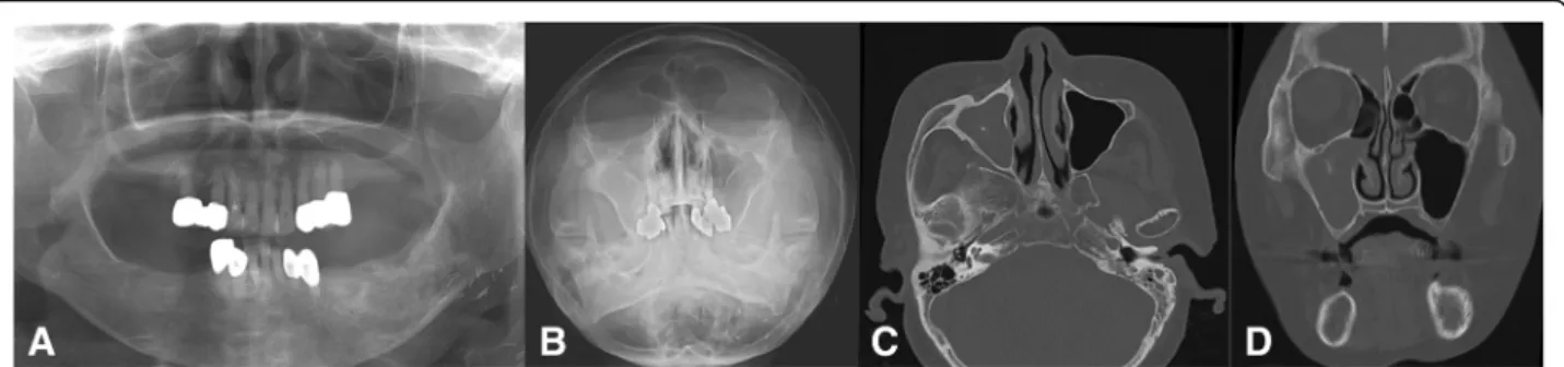 Fig. 7 Chronic maxillary sinusitis originating from the right second premolar, the crown of which was analyzed or continuous denture loading