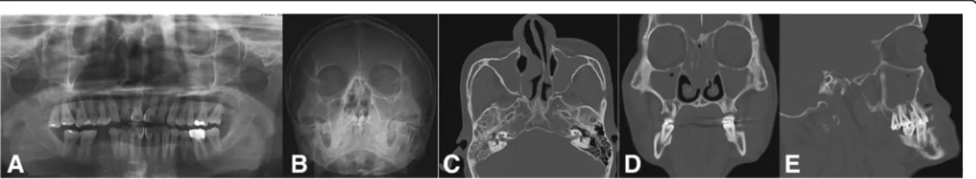 Fig. 9 Pan-sinusitis on both paranasal sinuses originating from the root infection of the right first molar