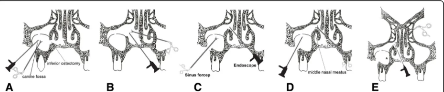 Fig. 10 Schematic drawings of surgical approaches in odontogenic maxillary sinusitis patients showing conventional CLP (a), FESS (b), and MESS (c, d, e)