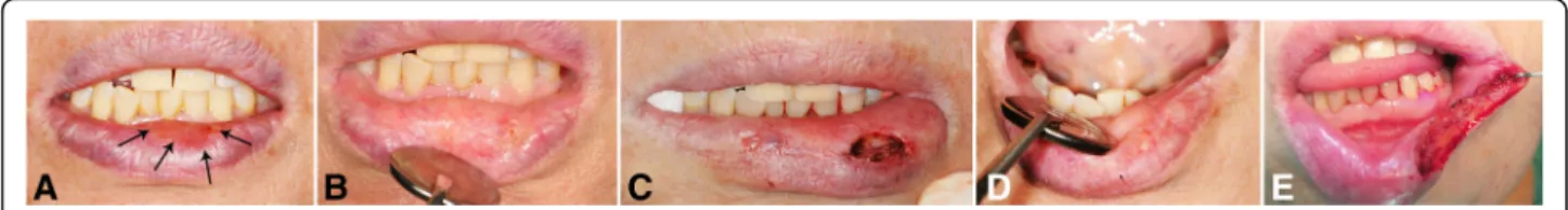Fig. 1 A 70-year-old Korean female exhibited a reticulated red plaque on her lower lip (a), disappearance after corticosteroid therapy for 3 months (b), re-appearance on the lateral side from its original location in an excisional biopsy state (c), whitish