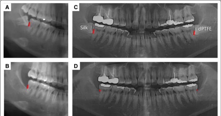 Fig. 2 Measurement of the bony defect. Bony defect is the distance between the cement –enamel junction and the bottom of the bony defect on the distal surface of the second molar