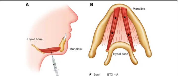 Fig. 1 A schematic illustration of the procedure. a Injection into the anterior belly of the digastric muscle was performed using a submental approach