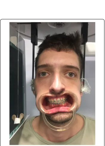 Fig. 3 The flat under-surface of the horizontal part of the measuring instrument is placed on the higher maxillary canine orthodontic bracket hook (though it may be placed on a unilateral segment of any bilateral structure), and held perpendicular to the t