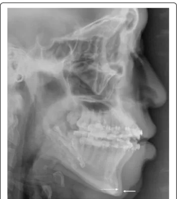 Fig. 4 An example of mandibular relapse after SFA. Pogonion position at the immediate postoperative mark (broken arrow), significantly moved forward after surgery with SFA (solid arrow) without any evidence of temporomandibular joint problemsKwon and Han M