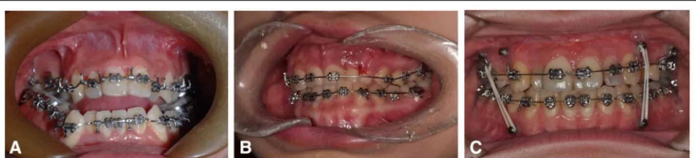 Fig. 7 An example of suggestions for the use of surgical archwires for surgery-first and conventional approaches for orthognathic surgery Fig
