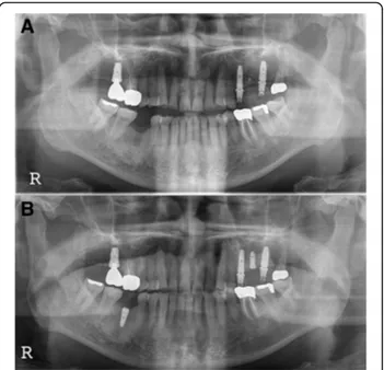 Fig. 3 M3, panoramic radiograph, a postoperative 1-month removal of fixture state, b #46i, second installation