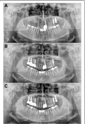 Fig. 7 F2, panoramic radiograph, a #27i second installation, b #27i second failure, preoperative panoramic radiograph, c #27i, third installation